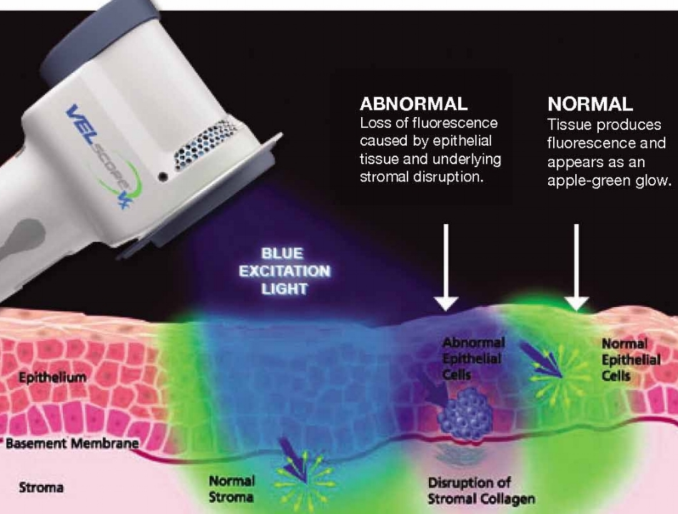 Oral Cancer Awareness The Importance Of Velscope Exam Routine Dental