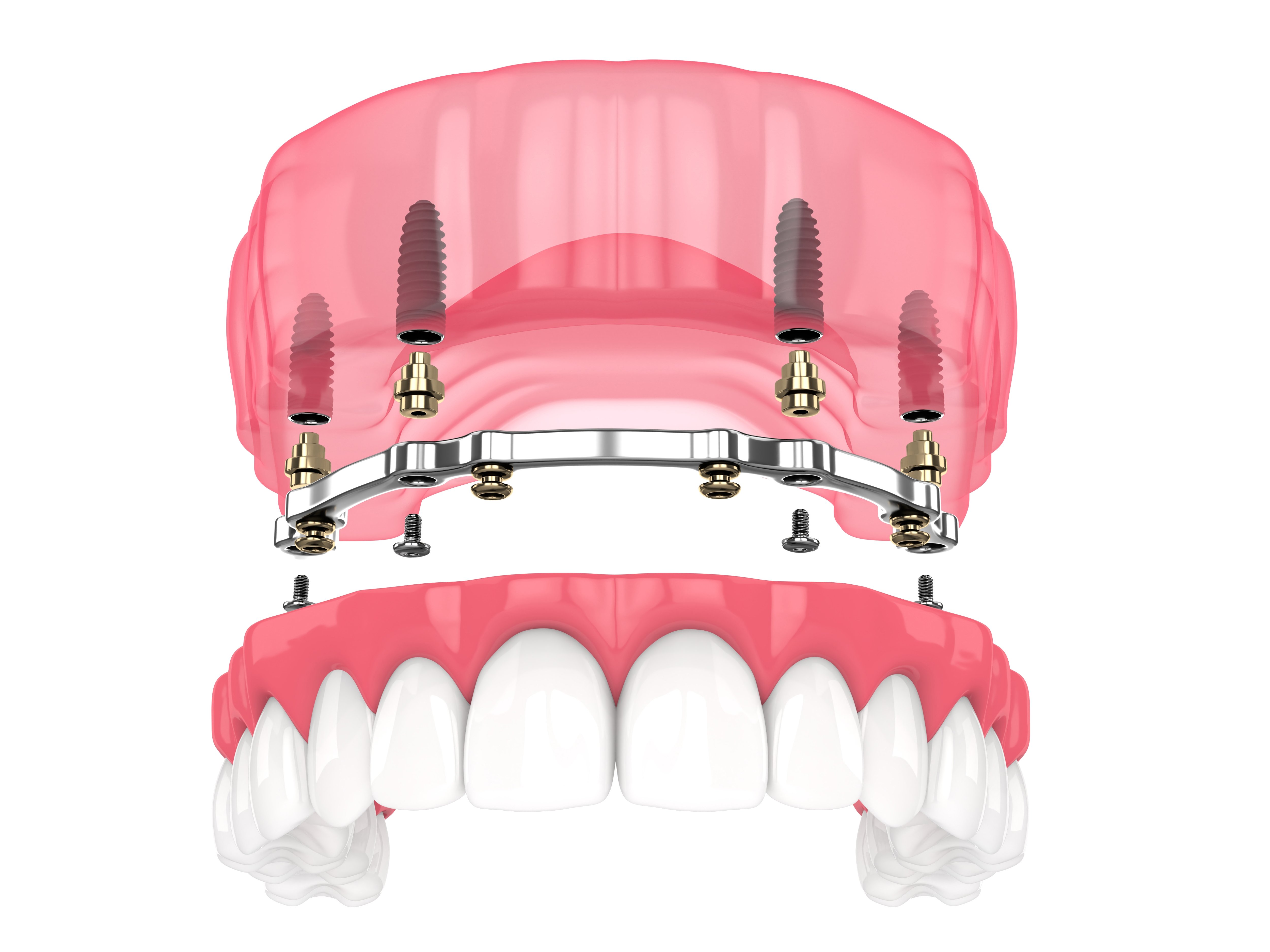 Are Upper Denture Implants Better Than Traditional Dentures?